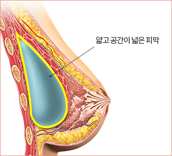 수술 후 정상가슴