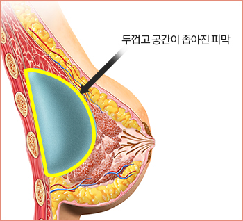 구형구축 진행