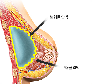 구형구축 진행