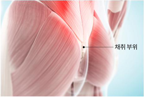 자가진피 채취 및 봉합