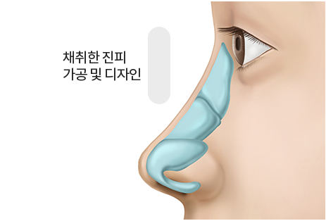 자가진피와 연골 디자인