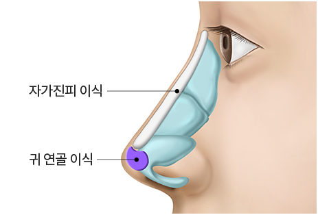 콧대-진피, 코끝 연골 이식