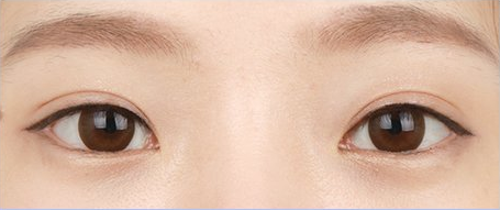 수술 후 3개월