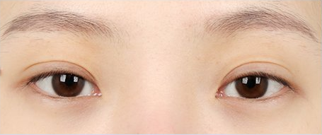 수술 전