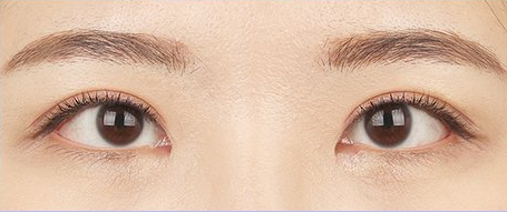 수술 후 3개월