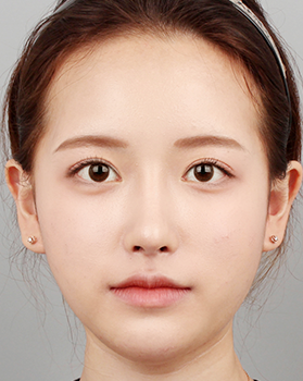 수술 후 정면