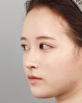 수술 후 측면