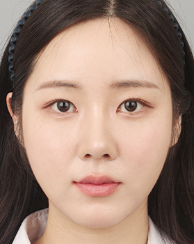 수술 후 정면