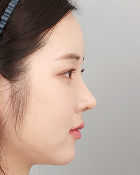 수술 후 측면
