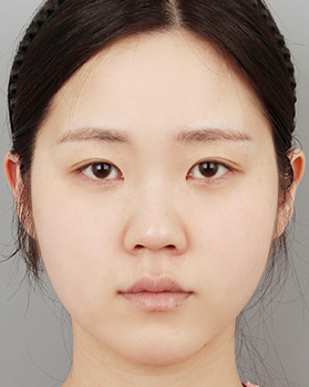 수술 전 정면