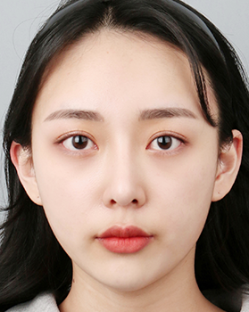 수술 후 정면