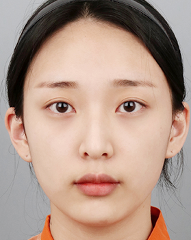수술 전 정면