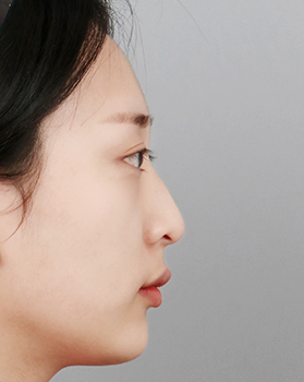 수술 전 측면
