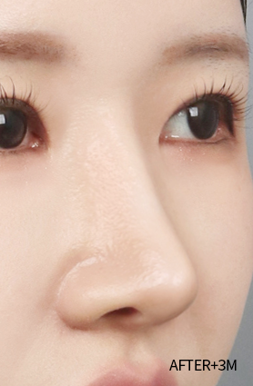 수술 후 3개월
